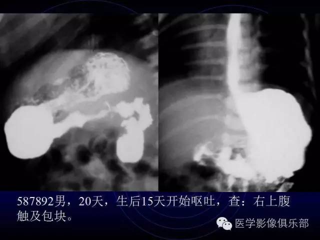 【PPT】婴幼儿消化道梗阻性疾病