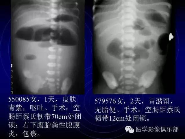 【PPT】婴幼儿消化道梗阻性疾病