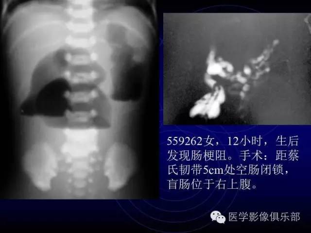 【PPT】婴幼儿消化道梗阻性疾病