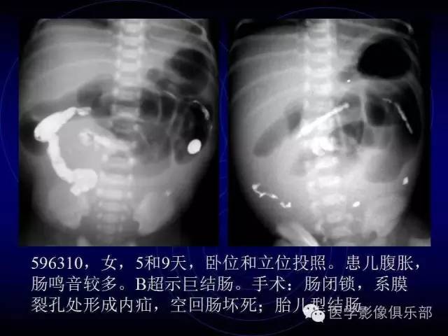 【PPT】婴幼儿消化道梗阻性疾病