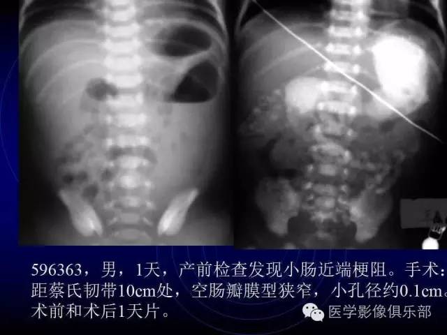 【PPT】婴幼儿消化道梗阻性疾病