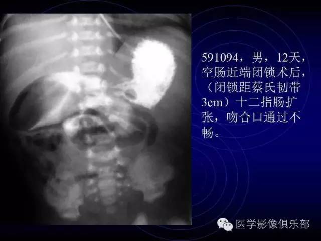 【PPT】婴幼儿消化道梗阻性疾病