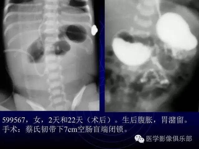 【PPT】婴幼儿消化道梗阻性疾病