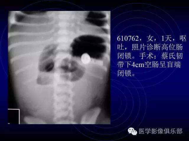 【PPT】婴幼儿消化道梗阻性疾病