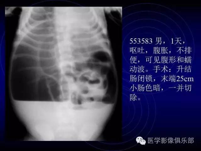 【PPT】婴幼儿消化道梗阻性疾病