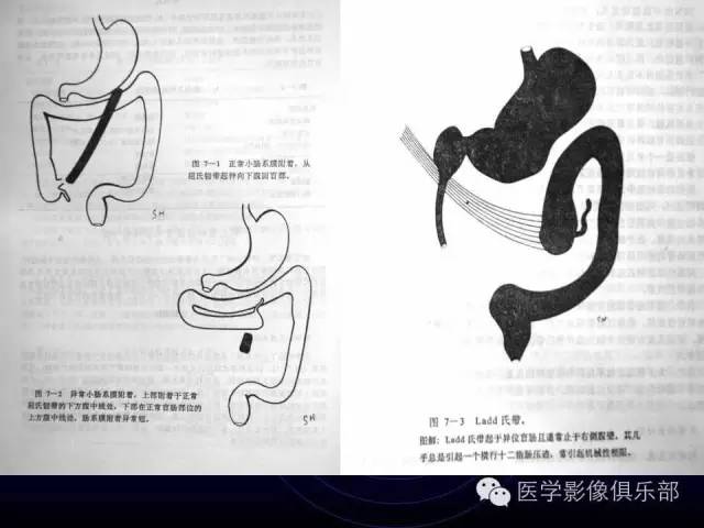 【PPT】婴幼儿消化道梗阻性疾病