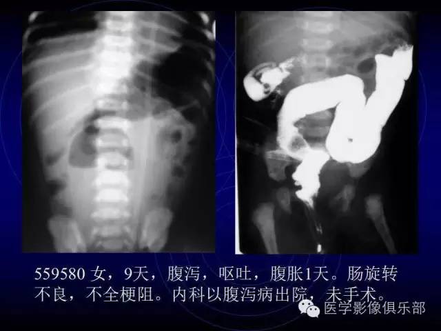 【PPT】婴幼儿消化道梗阻性疾病