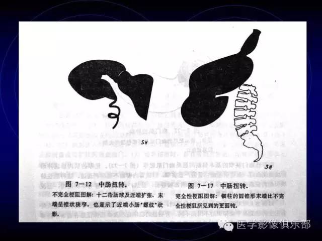【PPT】婴幼儿消化道梗阻性疾病