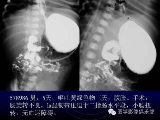 【PPT】婴幼儿消化道梗阻性疾病