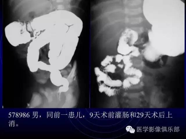 【PPT】婴幼儿消化道梗阻性疾病