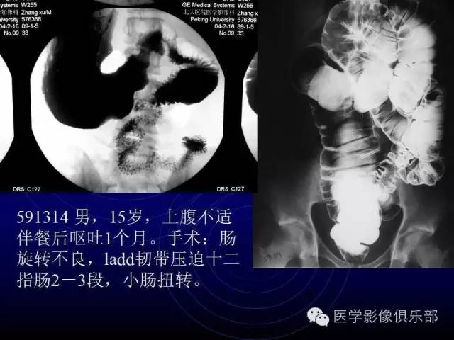 【PPT】婴幼儿消化道梗阻性疾病