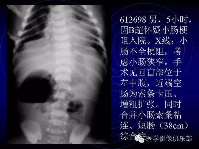 【PPT】婴幼儿消化道梗阻性疾病
