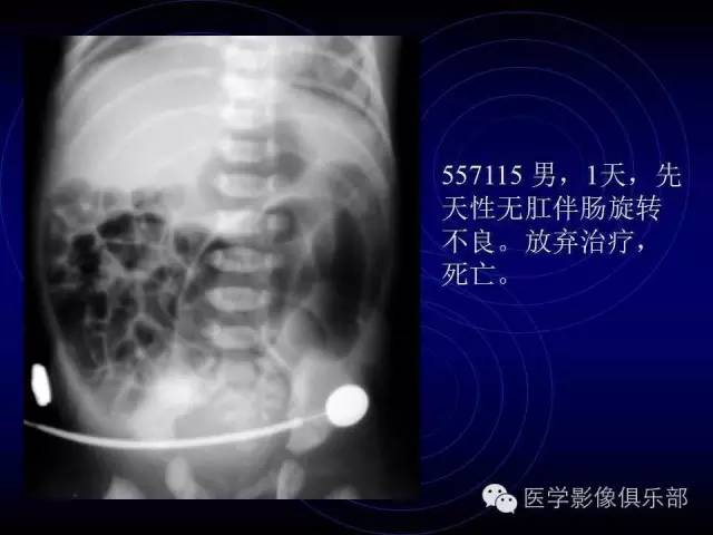 【PPT】婴幼儿消化道梗阻性疾病
