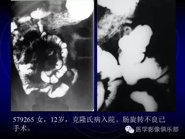 【PPT】婴幼儿消化道梗阻性疾病