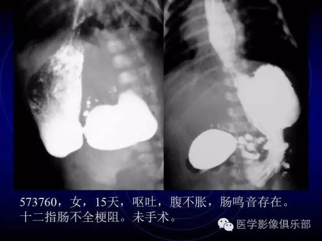 【PPT】婴幼儿消化道梗阻性疾病