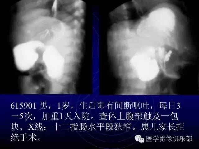 【PPT】婴幼儿消化道梗阻性疾病