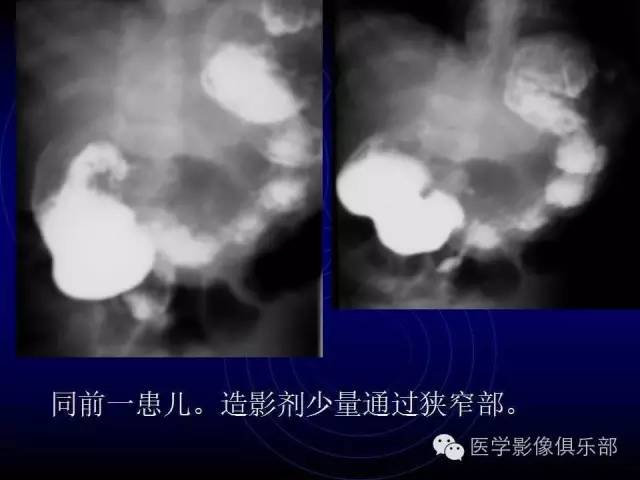【PPT】婴幼儿消化道梗阻性疾病