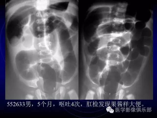 【PPT】婴幼儿消化道梗阻性疾病
