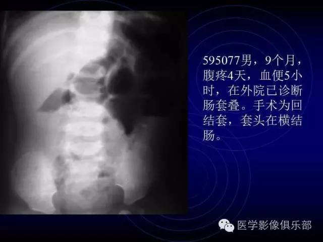 【PPT】婴幼儿消化道梗阻性疾病
