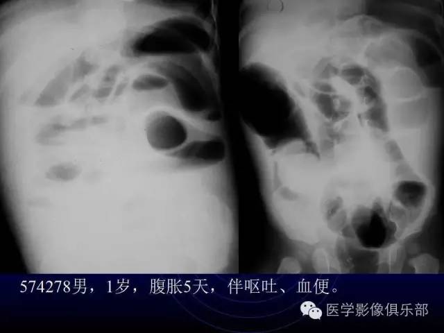 【PPT】婴幼儿消化道梗阻性疾病