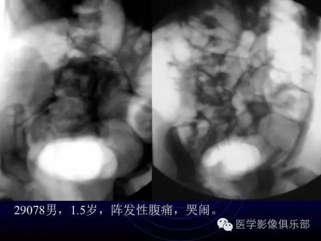 【PPT】婴幼儿消化道梗阻性疾病