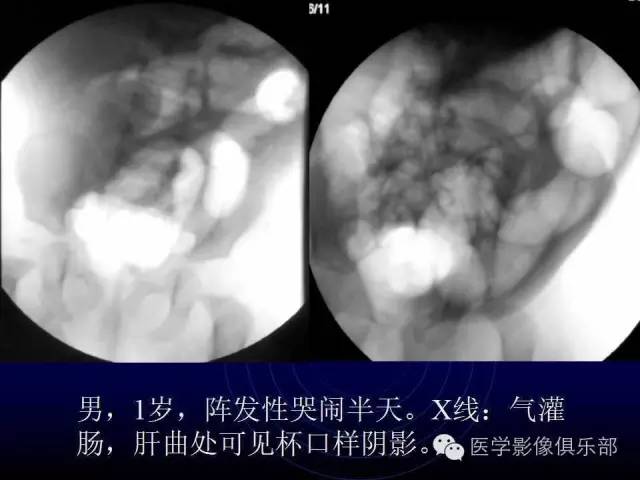 【PPT】婴幼儿消化道梗阻性疾病