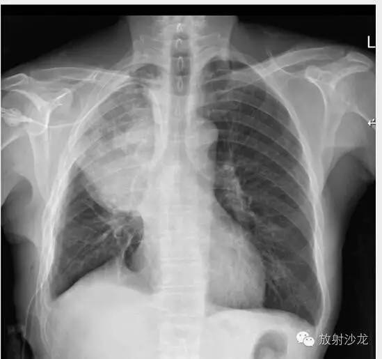 【病例】肺扭转一例X线及CT影像表现