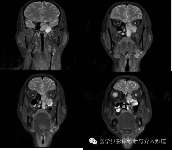 【病例】鼻窦神经鞘瘤1例CT及MR影像表现 【病例】鼻窦神经鞘瘤1例CT及MR影像表现