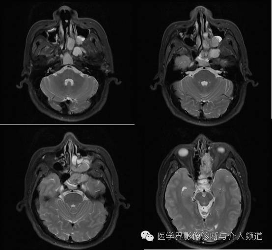 【病例】鼻窦神经鞘瘤1例CT及MR影像表现 【病例】鼻窦神经鞘瘤1例CT及MR影像表现