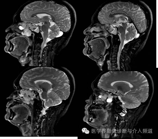 【病例】鼻窦神经鞘瘤1例CT及MR影像表现 【病例】鼻窦神经鞘瘤1例CT及MR影像表现
