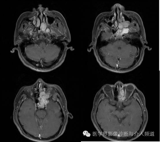 【病例】鼻窦神经鞘瘤1例CT及MR影像表现 【病例】鼻窦神经鞘瘤1例CT及MR影像表现