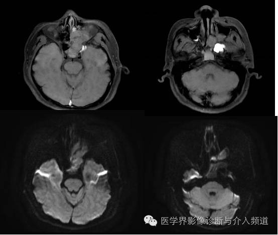 【病例】鼻窦神经鞘瘤1例CT及MR影像表现 【病例】鼻窦神经鞘瘤1例CT及MR影像表现