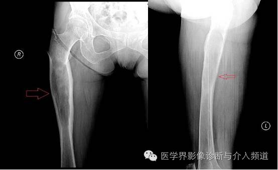 长骨髓腔侵袭性病变的鉴别诊断 长骨髓腔侵袭性病变的鉴别诊断