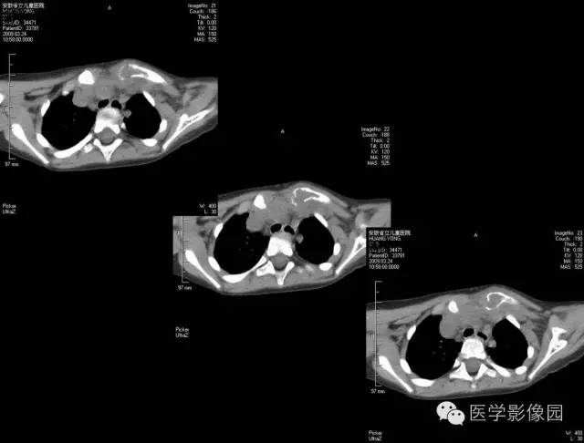 【病例】锁骨嗜酸性肉芽肿1例影像表现 【病例】锁骨嗜酸性肉芽肿1例影像表现