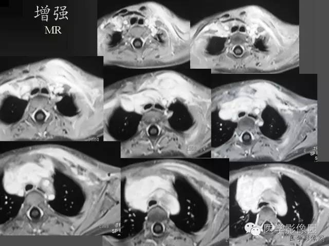 【病例】锁骨嗜酸性肉芽肿1例影像表现 【病例】锁骨嗜酸性肉芽肿1例影像表现