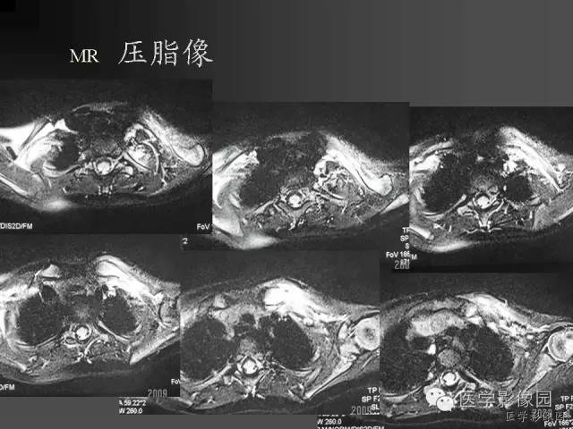 【病例】锁骨嗜酸性肉芽肿1例影像表现 【病例】锁骨嗜酸性肉芽肿1例影像表现
