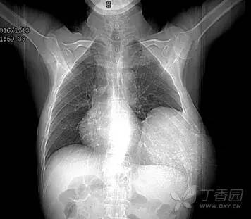 成软骨性肿瘤的影像诊断要点 成软骨性肿瘤的影像诊断要点