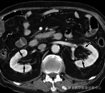 9种肾窦病变,看看看完能掌握几个 9种肾窦病变,看看看完能掌握几个