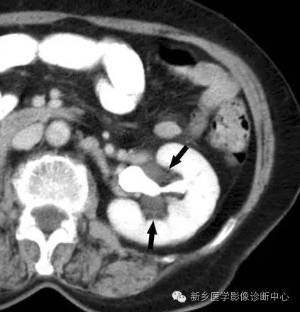 9种肾窦病变,看看看完能掌握几个 9种肾窦病变,看看看完能掌握几个