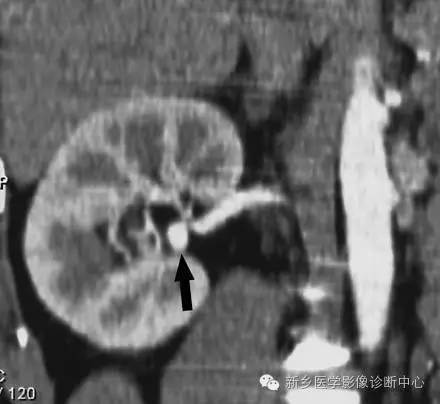 9种肾窦病变,看看看完能掌握几个 9种肾窦病变,看看看完能掌握几个