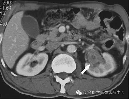 9种肾窦病变,看看看完能掌握几个 9种肾窦病变,看看看完能掌握几个