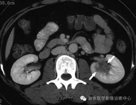 9种肾窦病变,看看看完能掌握几个 9种肾窦病变,看看看完能掌握几个
