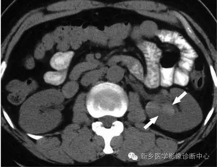 9种肾窦病变,看看看完能掌握几个 9种肾窦病变,看看看完能掌握几个