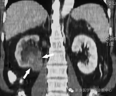 9种肾窦病变,看看看完能掌握几个 9种肾窦病变,看看看完能掌握几个