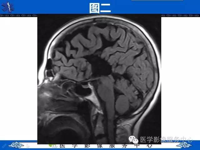 【影像征象】麋鹿头征and头盔征 ——胼胝体发育不全