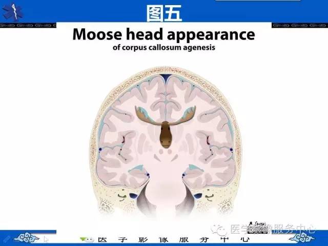 【影像征象】麋鹿头征and头盔征 ——胼胝体发育不全