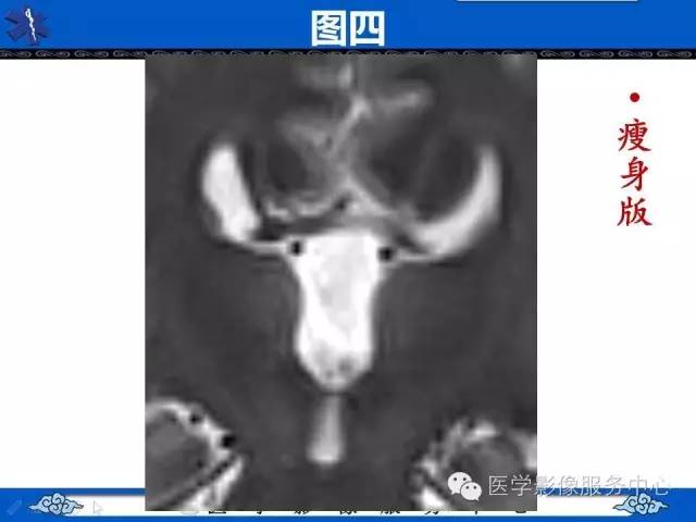【影像征象】麋鹿头征and头盔征 ——胼胝体发育不全