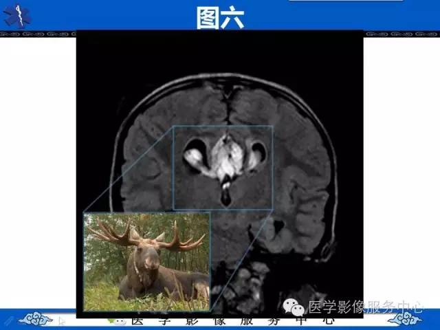 【影像征象】麋鹿头征and头盔征 ——胼胝体发育不全
