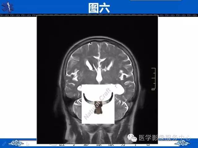 【影像征象】麋鹿头征and头盔征 ——胼胝体发育不全