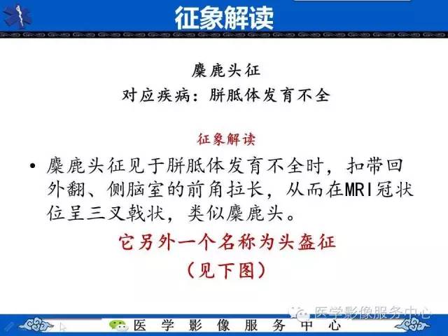 【影像征象】麋鹿头征and头盔征 ——胼胝体发育不全